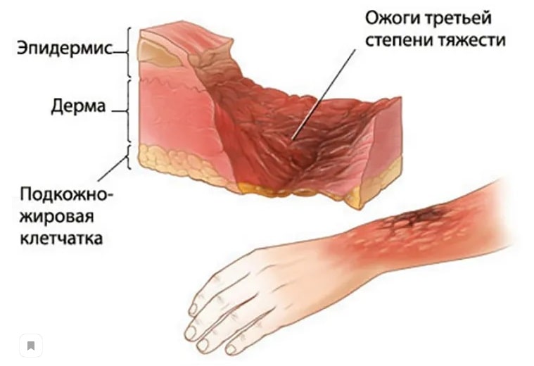 Ксероз - причины появления и лечение чрезмерной сухости кожи